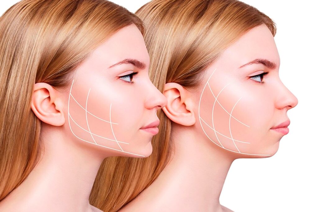 qué es la marcación mandibular con ácido hialurónico